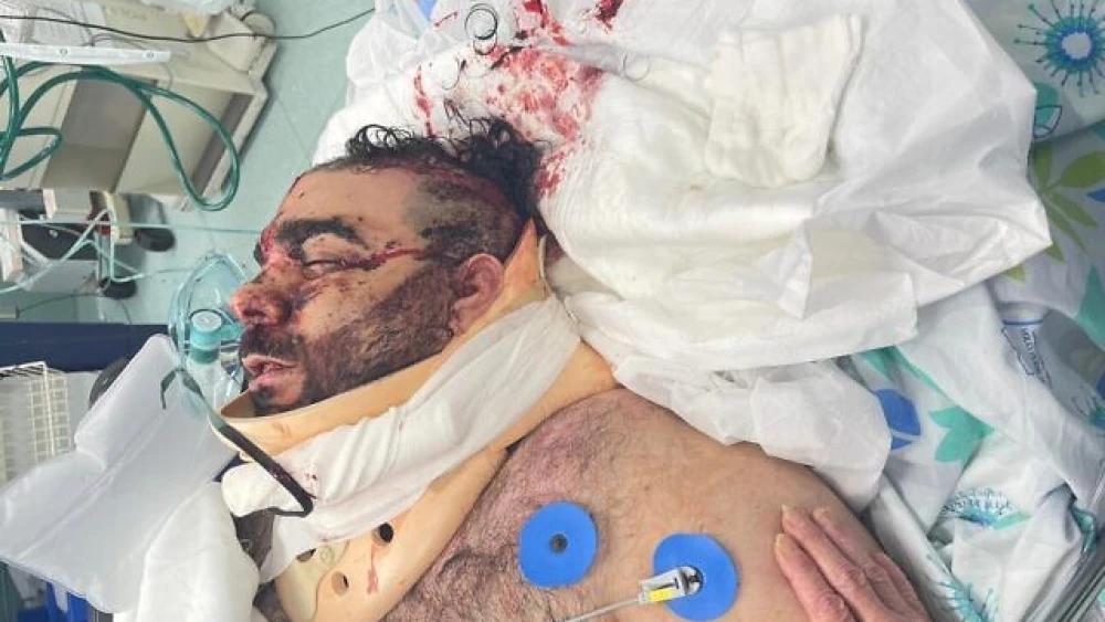 Mor Ganashvili in the hospital, soon after he was attacked, May 2021. Credit: Courtesy.
