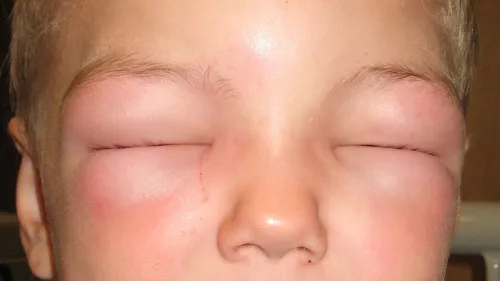 This child suffers from anaphylaxis and cannot open his eyes due to swelling. James Heilman, M.D., Wikimedia Commons.
