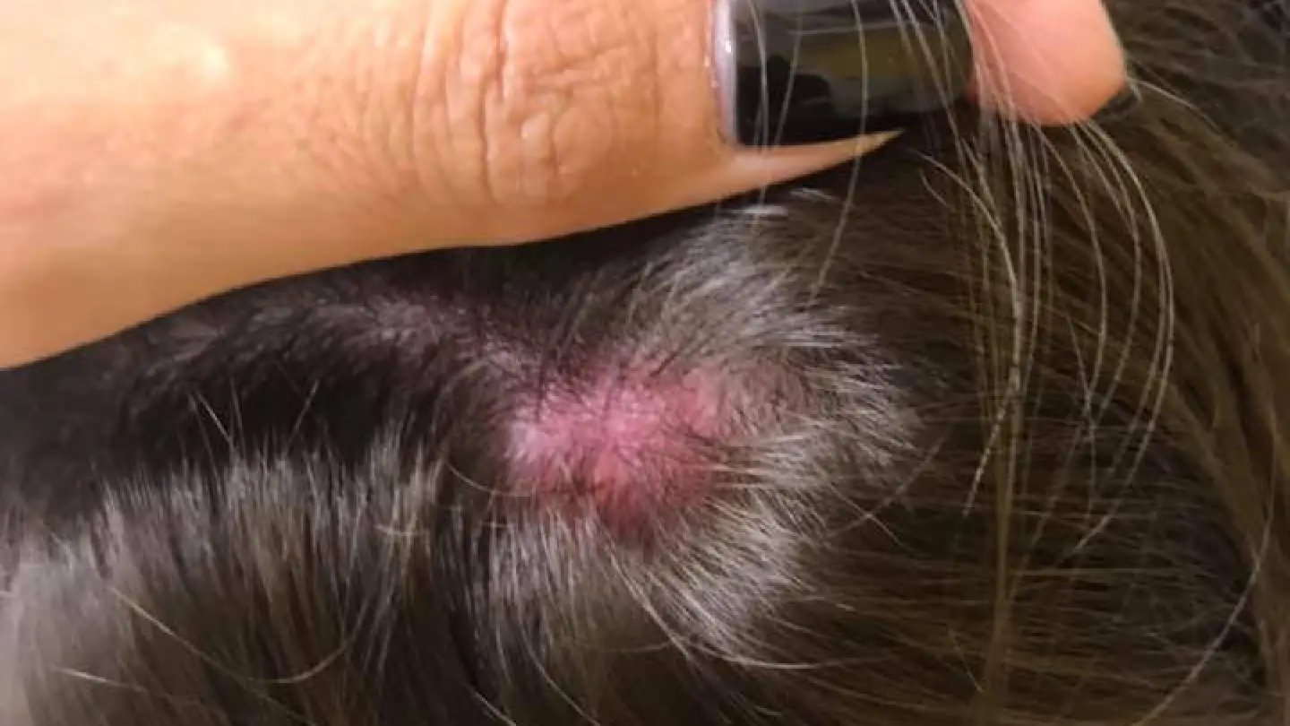 Petach Tikva resident Ginat Greenwald pointing to injuries that her nine-year-old special-needs daughter, Lihi, sustained in school in Sept. 2020. Source: Facebook.