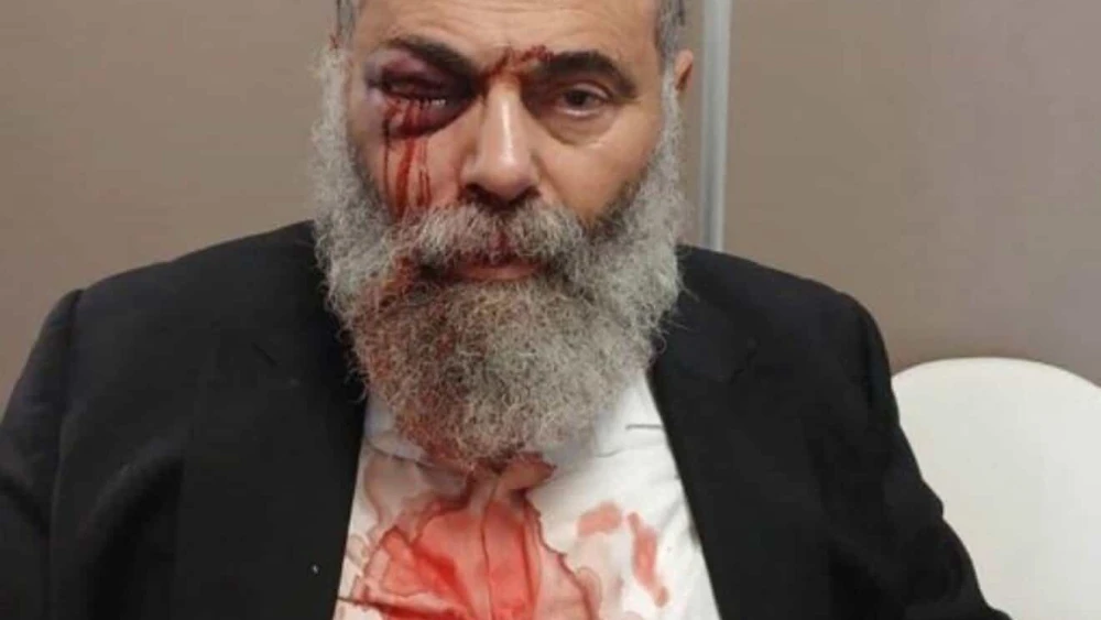Gilles Cohen, a 67-year-old observant Jew, was attacked on antisemitic grounds on Sep. 27, 2025, in Yerres (Essonne), a suburb south of Paris. Credit: Cohen’s family.