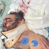 Mor Ganashvili in the hospital, soon after he was attacked, May 2021. Credit: Courtesy.