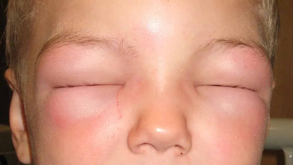 This child suffers from anaphylaxis and cannot open his eyes due to swelling. James Heilman, M.D., Wikimedia Commons.