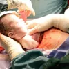 A baby boy born after an ex-utero intrapartum procedure at Tel Aviv Sourasky Medical Center on Oct. 14, 2020. Credit: Courtesy.