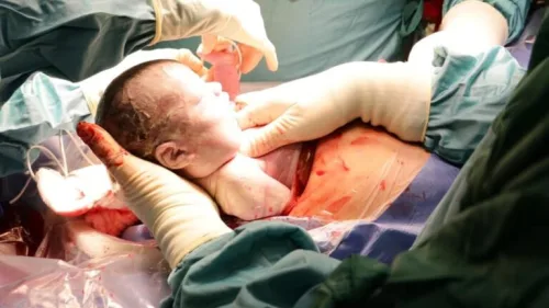 A baby boy born after an ex-utero intrapartum procedure at Tel Aviv Sourasky Medical Center on Oct. 14, 2020. Credit: Courtesy.