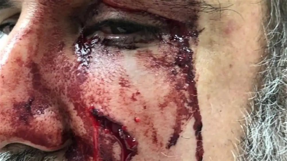 Injury, Judicial Reform Protests