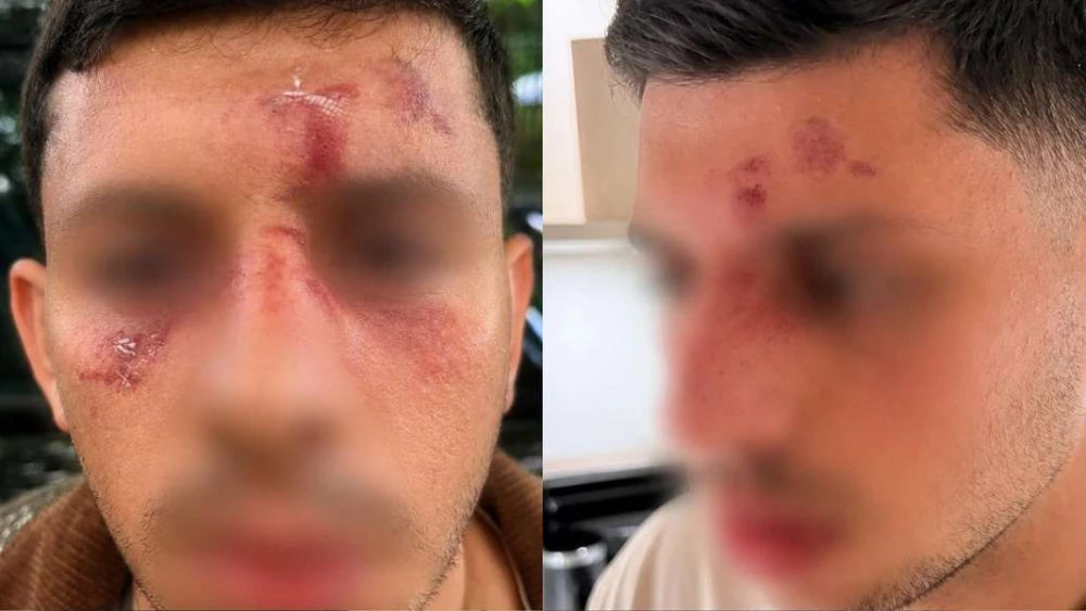 Shalev Ben Yakar after his assault in London, U.K., on May 18, 2026. Photo courtesy of Ben Yakar.